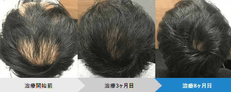 AGAヘアクリニックの症例写真