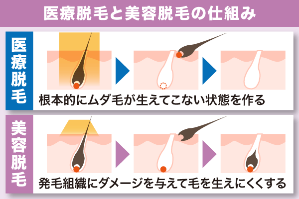 医療脱毛と美容脱毛の仕組み比較図