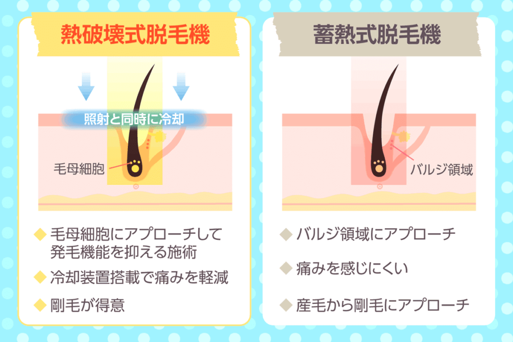 熱破壊式脱毛機と蓄熱式脱毛機の違い